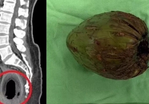 Cirurgiões removem coco verde de 9 cm do ânus de homem em Taiwan